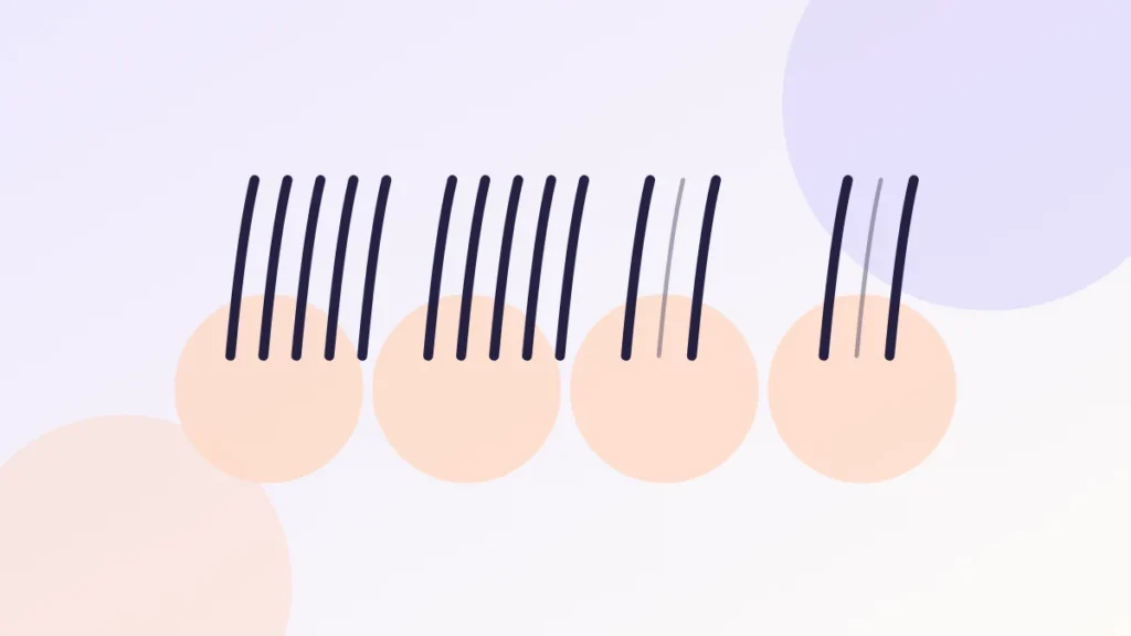 Illustration comparing the outline of hair loss patterns across successive Norwood stages