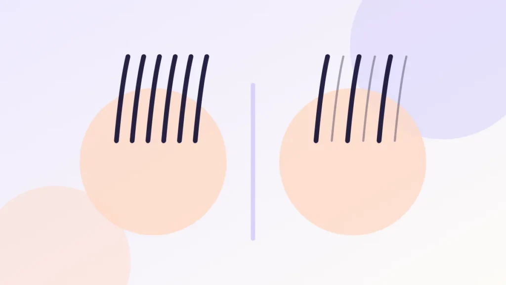 Illustration comparing a low juvenile hairline with a slightly receded adult hairline and an asymmetric M-shaped recession