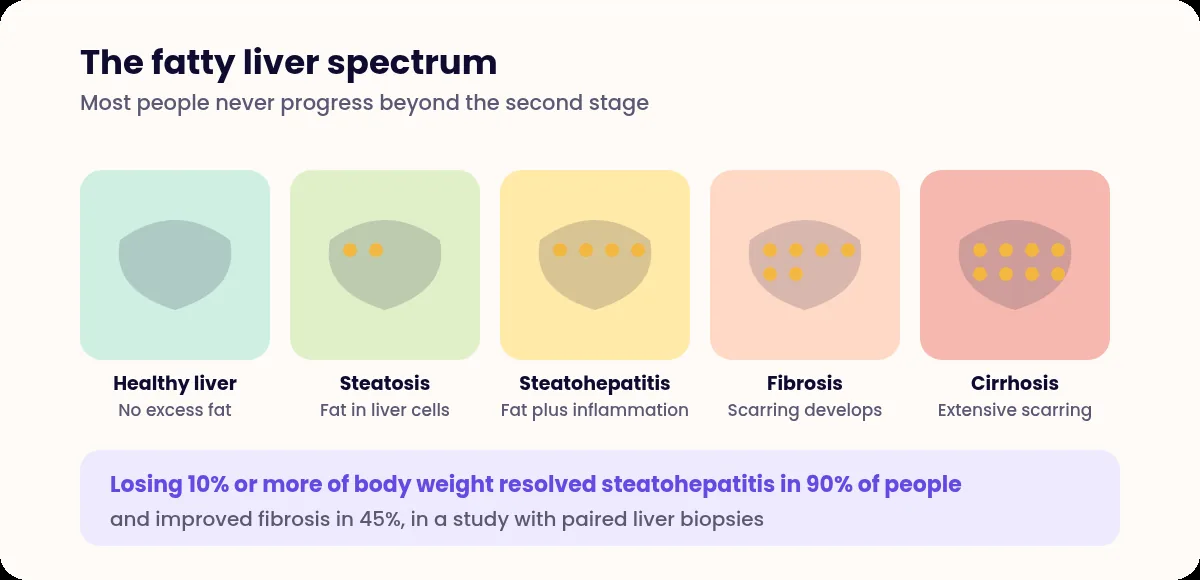 Five panels showing the progression from a healthy liver through fat accumulation, inflammation, scarring and cirrhosis